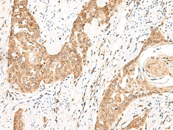 Immunohistochemistry of paraffin-embedded Human esophagus cancer tissue  using PPP1R3C Polyclonal Antibody at dilution of 1:50(?200)