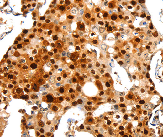 Immunohistochemistry of paraffin-embedded Human breast cancer using Proliferating Cell Nuclear Antigen Polyclonal Antibody at dilution of 1:44