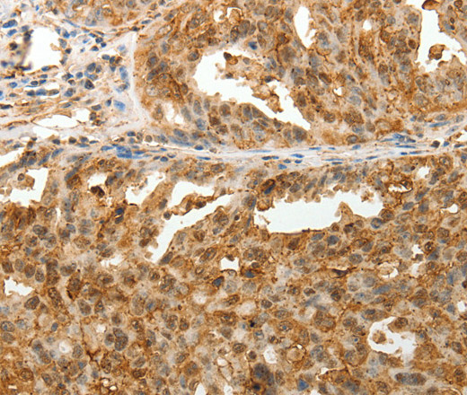 Immunohistochemistry of paraffin-embedded Human ovarian cancer tissue using TENM3 Polyclonal Antibody at dilution 1:50