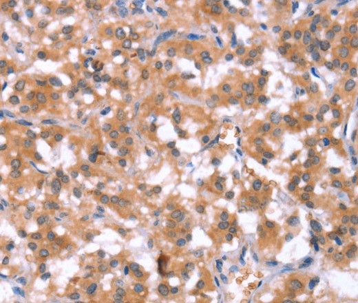 Immunohistochemistry of paraffin-embedded Human thyroid cancer tissue using HCAR2 Polyclonal Antibody at dilution 1:40