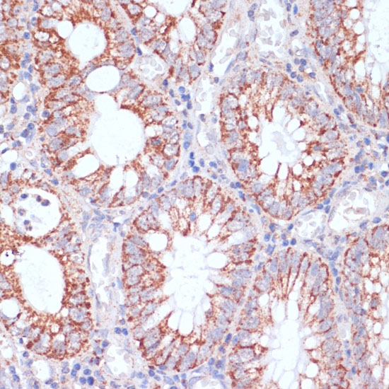 Immunohistochemistry of paraffin-embedded Human colon carcinoma using HIGD1A Polyclonal Antibody at dilution of  1:100 (40x lens).