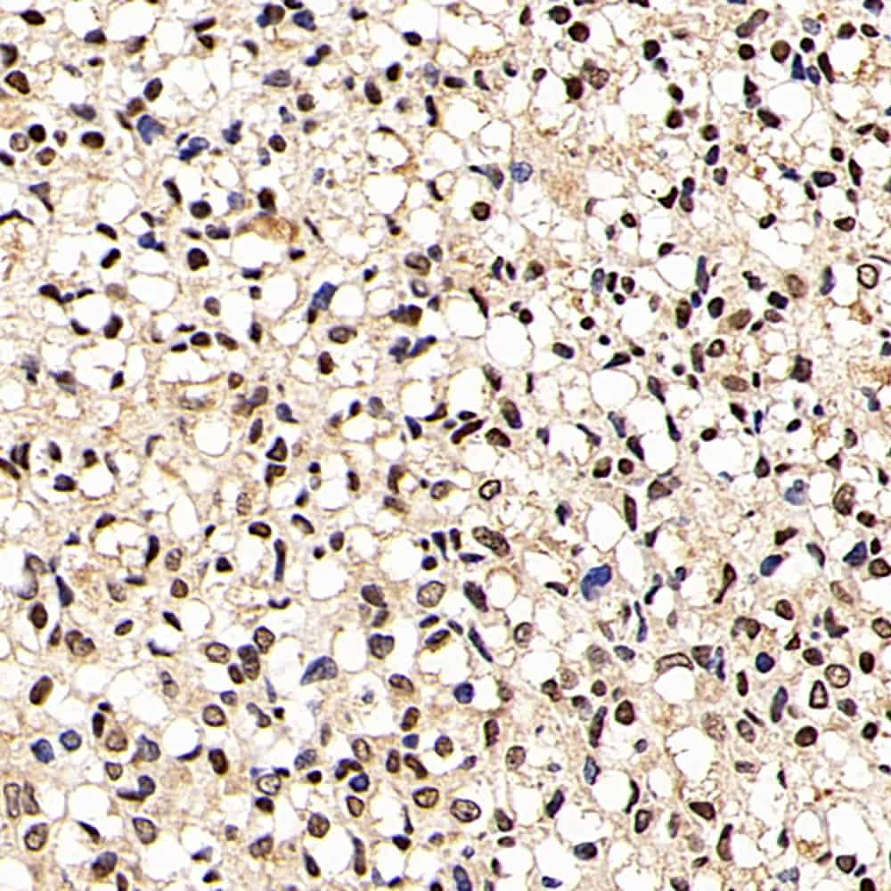 Immunohistochemistry analysis of paraffin-embedded human liver cancer  using p27 Polyclonal Antibody at dilution of 1:200.