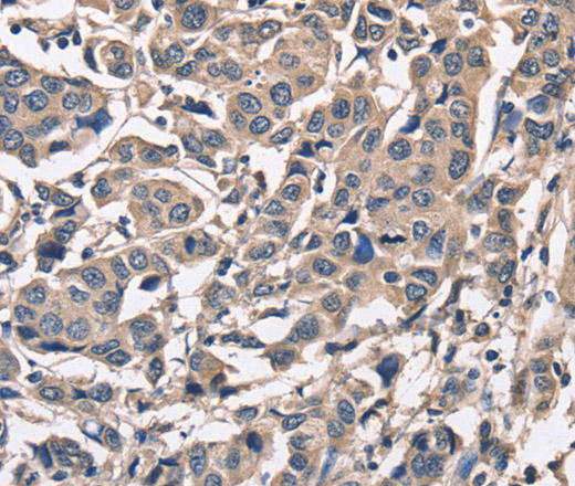 Immunohistochemistry of paraffin-embedded Human breast cancer using PEBP1 Polyclonal Antibody at dilution of 1:50