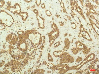 Immunohistochemistry of paraffin-embedded Human breast carcinoma tissue using p70 S6 kinase alpha Monoclonal Antibody at dilution of 1:200.