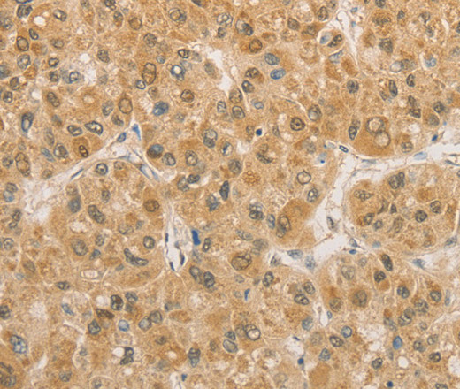 Immunohistochemistry of paraffin-embedded Human liver cancer using PGK2 Polyclonal Antibody at dilution of 1:50