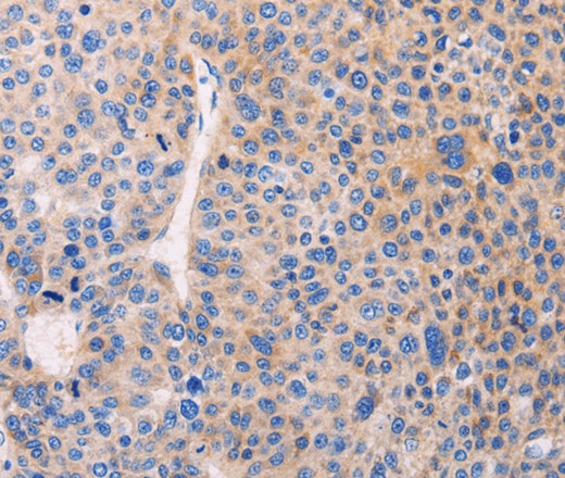 Immunohistochemistry of paraffin-embedded Human liver cancer using ADCY1 Polyclonal Antibody at dilution of 1:60