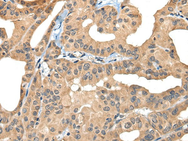 Immunohistochemistry of paraffin-embedded Human thyroid cancer tissue  using BHMT2 Polyclonal Antibody at dilution of 1:30(?200)