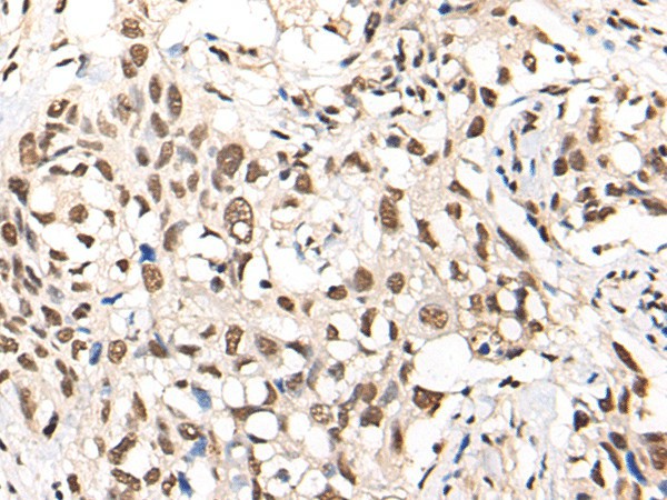 Immunohistochemistry of paraffin-embedded Human lung cancer tissue  using MTA2 Polyclonal Antibody at dilution of 1:40(?200)