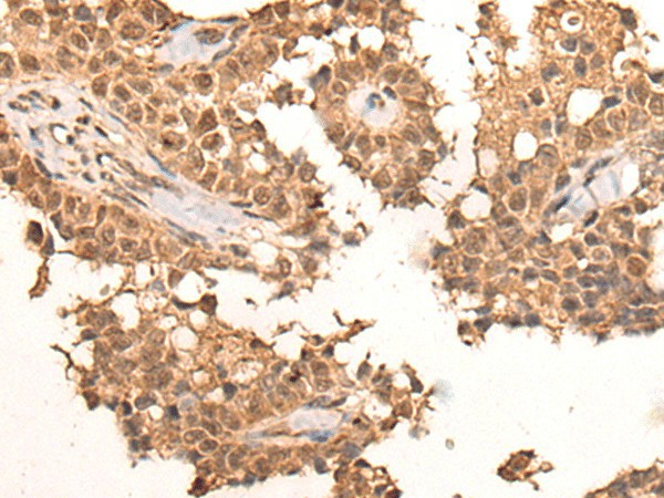 Immunohistochemistry of paraffin-embedded Human ovarian cancer tissue  using CLK2 Polyclonal Antibody at dilution of 1:45(?200)