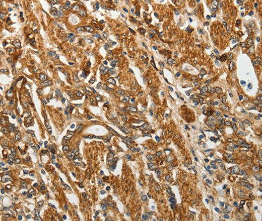 Immunohistochemistry of paraffin-embedded Human gastic cancer using RPLP0 Polyclonal Antibody at dilution of 1:40