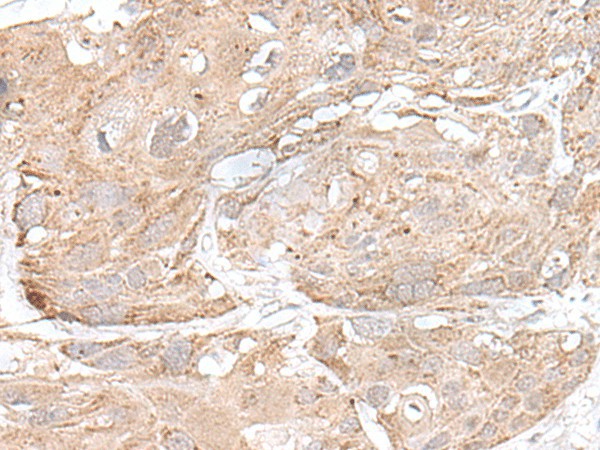 Immunohistochemistry of paraffin-embedded Human esophagus cancer tissue  using SNRNP25 Polyclonal Antibody at dilution of 1:65(?200)