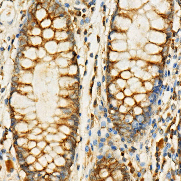 Immunohistochemistry of paraffin-embedded human colon carcinoma using EIF4G1 Polyclonal Antibody at dilution of 1:100 (40x lens).Perform high pressure antigen retrieval with 10 mM citrate buffer pH 6.0 before commencing with IHC staining protocol.