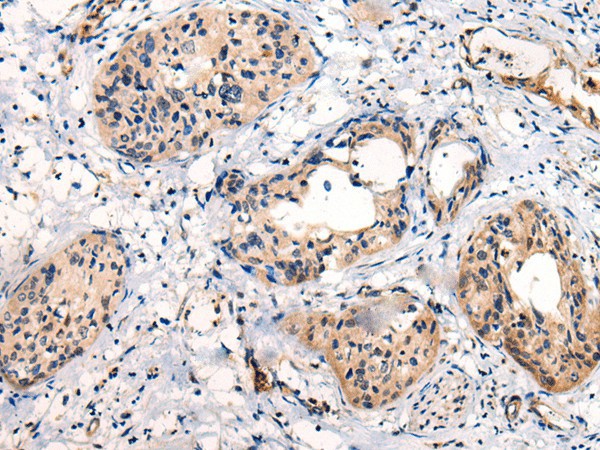 Immunohistochemistry of paraffin-embedded Human cervical cancer tissue  using C16orf45 Polyclonal Antibody at dilution of 1:45(?200)