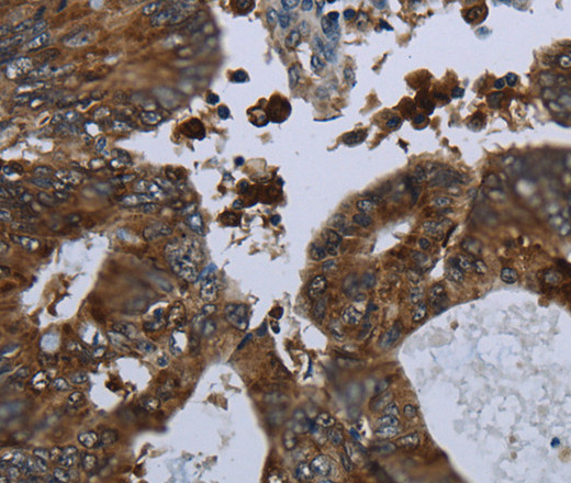 Immunohistochemistry of paraffin-embedded Human colon cancer using GLUL Polyclonal Antibody at dilution of 1:60