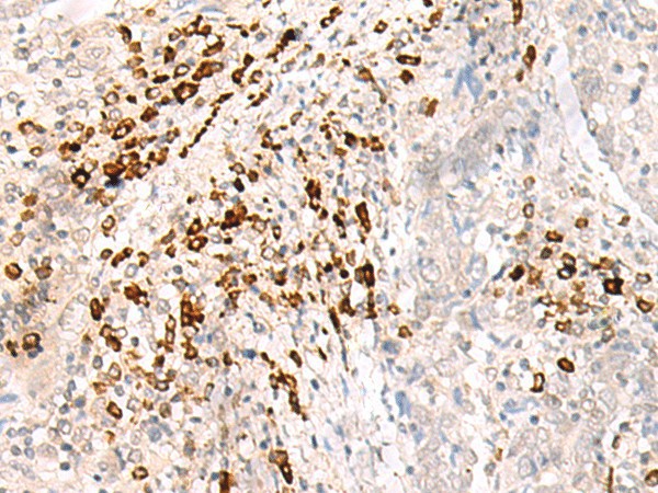 Immunohistochemistry of paraffin-embedded Human cervical cancer tissue  using HLA-B Polyclonal Antibody at dilution of 1:30(?200)