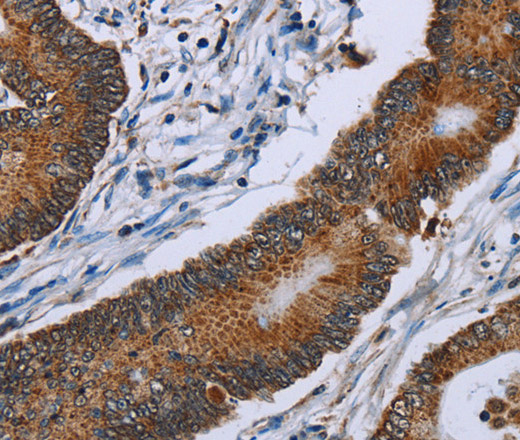 Immunohistochemistry of paraffin-embedded Human colon cancer using IDH2 Polyclonal Antibody at dilution of 1:60