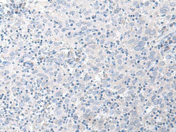 Immunohistochemistry of paraffin-embedded Human cervical cancer tissue  using STAU2 Polyclonal Antibody at dilution of 1:45(?200)