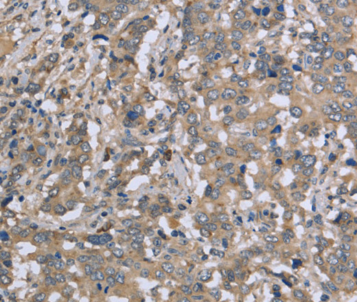 Immunohistochemistry of paraffin-embedded Human liver cancer tissue using DTNB Polyclonal Antibody at dilution 1:50