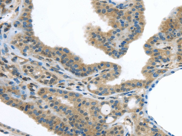 Immunohistochemistry of paraffin-embedded Human thyroid cancer tissue using VLDLR Polyclonal Antibody at dilution 1:40