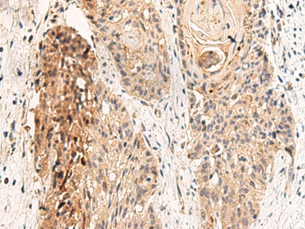 Immunohistochemistry of paraffin-embedded Human esophagus cancer tissue  using GPR152 Polyclonal Antibody at dilution of 1:45(?200)