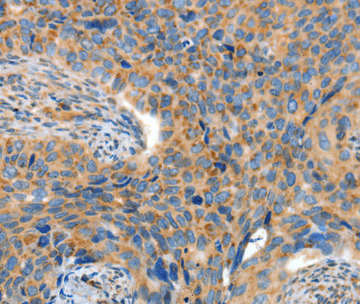 Immunohistochemistry of paraffin-embedded Human cervical cancer tissue using ADAMTS18 Polyclonal Antibody at dilution 1:30