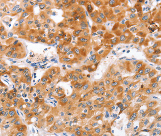 Immunohistochemistry of paraffin-embedded Human lung cancer tissue using NOD1 Polyclonal Antibody at dilution 1:50