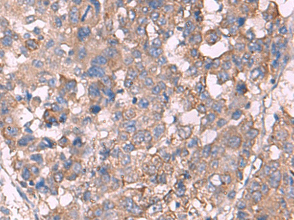 Immunohistochemistry of paraffin-embedded Human liver cancer tissue  using KCNN3 Polyclonal Antibody at dilution of 1:60(?200)