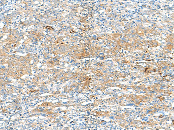 Immunohistochemistry of paraffin-embedded Human cervical cancer tissue  using HLA-DRB3 Polyclonal Antibody at dilution of 1:50(?200)