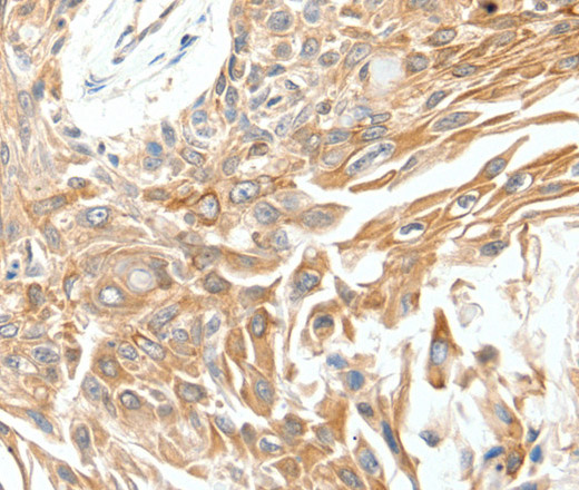 Immunohistochemistry of paraffin-embedded Human breast cancer tissue using SCN11A Polyclonal Antibody at dilution 1:40