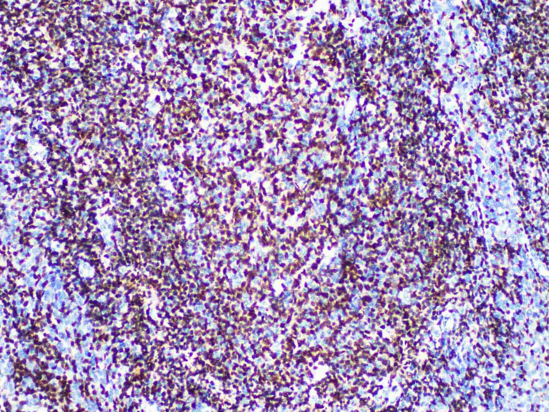 Immunohistochemistry of paraffinembedded Human tonsil tissue with OCT 2 Monoclonal Antibody(Antigen repaired by EDTA).