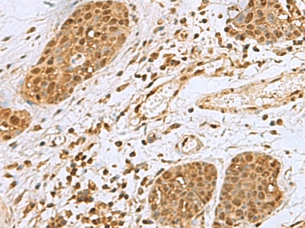 Immunohistochemistry of paraffin-embedded Human esophagus cancer tissue  using NVL Polyclonal Antibody at dilution of 1:80(?200)