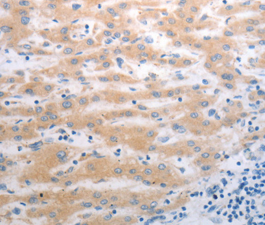 Immunohistochemistry of paraffin-embedded Human liver cancer using PAK1 Polyclonal Antibody at dilution of 1:40