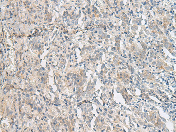 Immunohistochemistry of paraffin-embedded Human cervical cancer tissue  using PCSK5 Polyclonal Antibody at dilution of 1:50(?200)