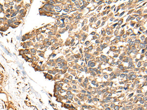 Immunohistochemistry of paraffin-embedded Human esophagus cancer tissue  using RCAN3 Polyclonal Antibody at dilution of 1:60(?200)