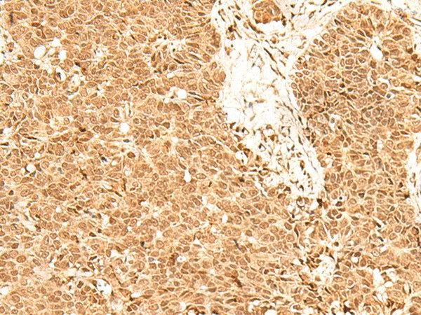 Immunohistochemistry of paraffin-embedded Human ovarian cancer tissue  using ADRM1 Polyclonal Antibody at dilution of 1:70(?200)