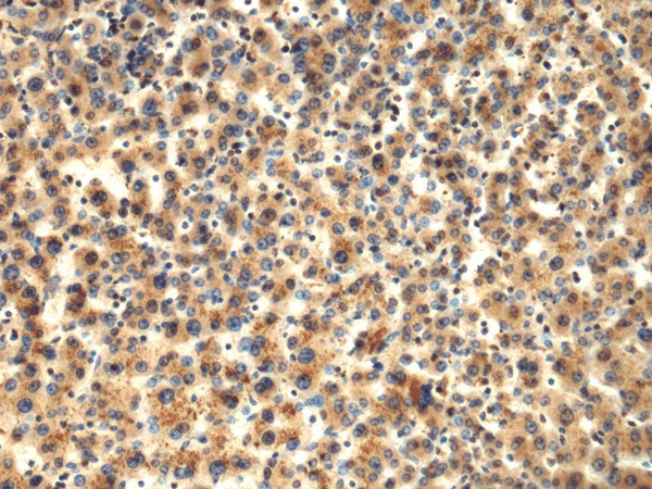 Immunohistochemistry of paraffin-embedded Human liver cancer tissue  using TMOD1 Polyclonal Antibody at dilution of 1:65(?200)