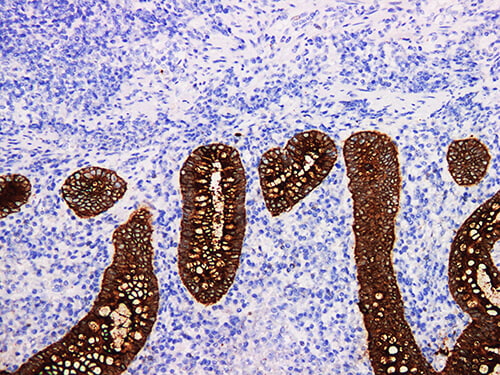 Immunohistochemistry of paraffinembedded Human appendix tissue with CEA Monoclonal Antibody(Antigen repaired by EDTA).