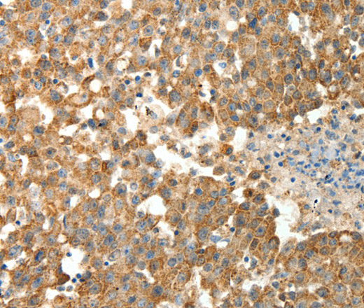 Immunohistochemistry of paraffin-embedded Human breast cancer using PRDX3 Polyclonal Antibody at dilution of 1:50