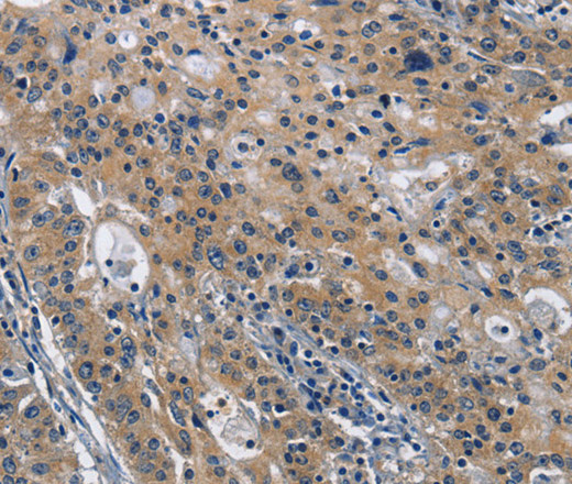 Immunohistochemistry of paraffin-embedded Human gastric cancer using CD160 Polyclonal Antibody at dilution of 1:30