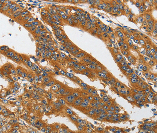 Immunohistochemistry of paraffin-embedded Human gastric cancer tissue using PI 3 Kinase Class 3 Polyclonal Antibody at dilution 1:40