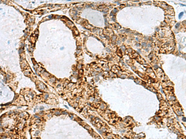 Immunohistochemistry of paraffin-embedded Human thyroid cancer tissue  using MED31 Polyclonal Antibody at dilution of 1:100(?200)