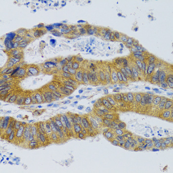 Immunohistochemistry of paraffin-embedded Human colorectal cancer using MBL2 Polyclonal antibody at dilution of 1:100 (40x lens).Perform microwave antigen retrieval with 10 mM PBS buffer pH 7.2 before commencing with IHC staining protocol