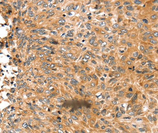 Immunohistochemistry of paraffin-embedded Human esophagus cancer tissue using ABCC9 Polyclonal Antibody at dilution 1:50