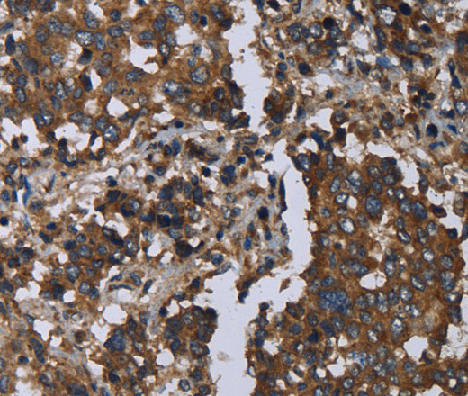 Immunohistochemistry of paraffin-embedded Human liver cancer using GOLGA2 Polyclonal Antibody at dilution of 1:60