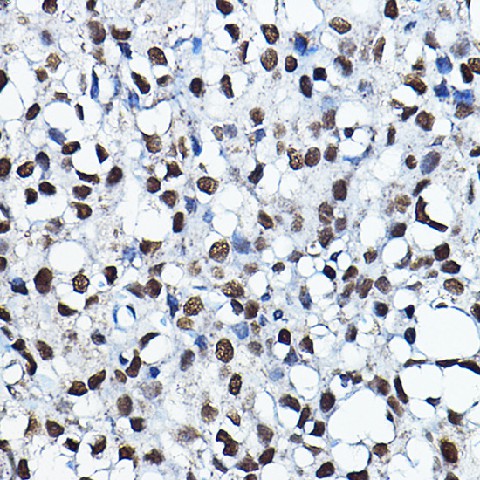 Immunohistochemistry of paraffin-embedded human breast cancer using KAT7 Polyclonal antibody at dilution of 1:100 (40x lens).Perform microwave antigen retrieval with 10 mM PBS buffer pH 7.2 before commencing with IHC staining protocol.