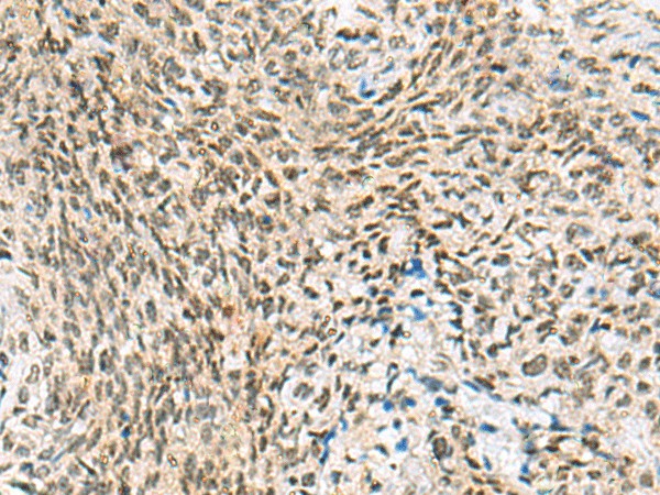 Immunohistochemistry of paraffin-embedded Human cervical cancer tissue  using C3orf38 Polyclonal Antibody at dilution of 1:95(?200)