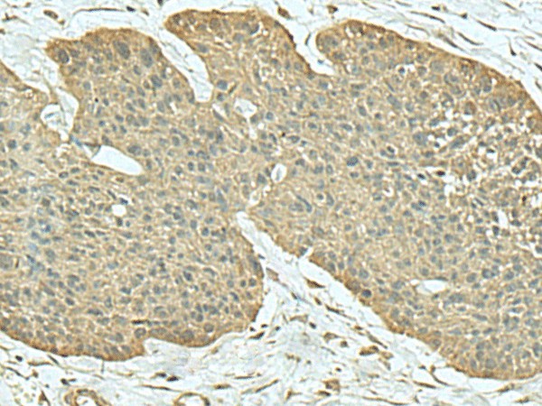 Immunohistochemistry of paraffin-embedded Human esophagus cancer tissue  using FN3KRP Polyclonal Antibody at dilution of 1:55(?200)