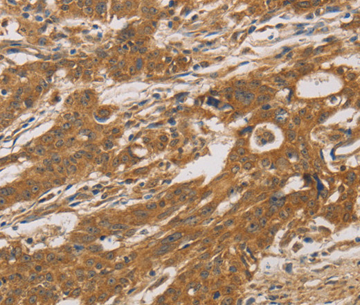 Immunohistochemistry of paraffin-embedded Human gastric cancer tissue using CYP17A1 Polyclonal Antibody at dilution 1:30