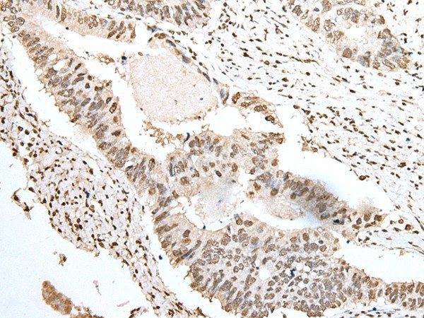 Immunohistochemistry of paraffin-embedded Human colorectal cancer tissue  using SNRPA Polyclonal Antibody at dilution of 1:55(?200)