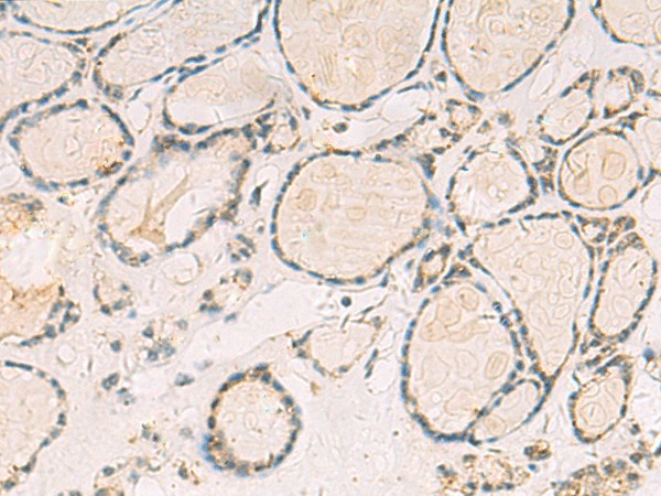 Immunohistochemistry of paraffin-embedded Human thyroid cancer tissue  using TCAP Polyclonal Antibody at dilution of 1:55(?200)